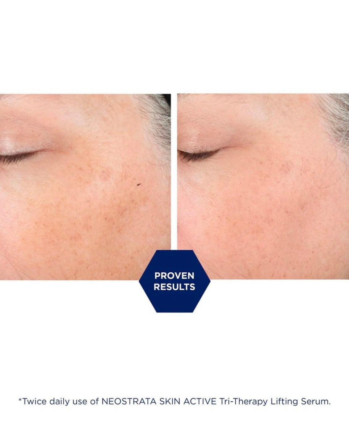 Tri-Therapy Lifting Serum con MicroDiPeptide229® - Anti-arrugas triple solución con acido hialurónico.