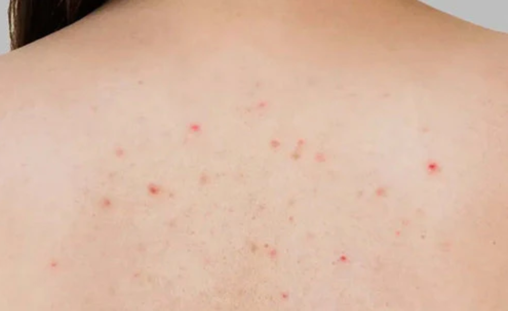 Acne Back & Chest Treatment Spray